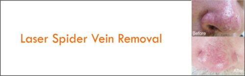 Laser Spider Vein Removal 1200x373 1