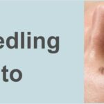 Micro Needling Nell Laser Cosmetic Clinic